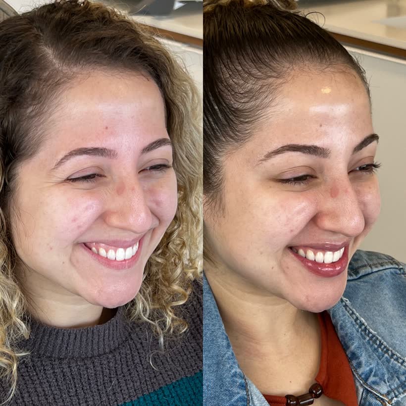 Antes e depois: Botox nos pés de galinha