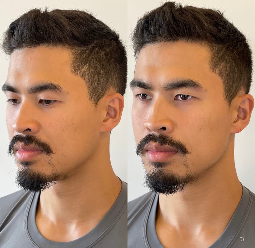 Antes e depois: Contorno mandibular