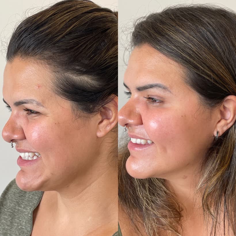 Antes e depois: Harmonização facial