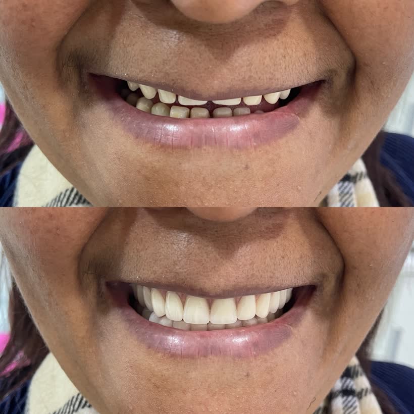 Antes e depois de reabilitação do sorriso, paciente da clínica