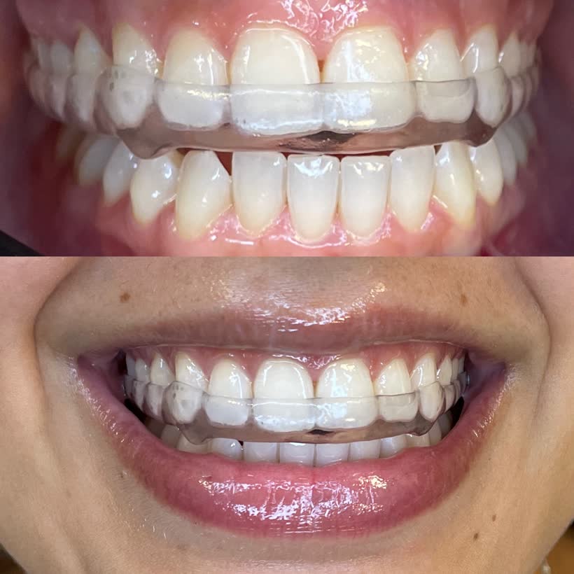 Antes e depois: Placa de bruxismo