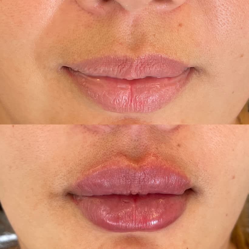 Antes e depois de preenchimento labial, paciente da clínica