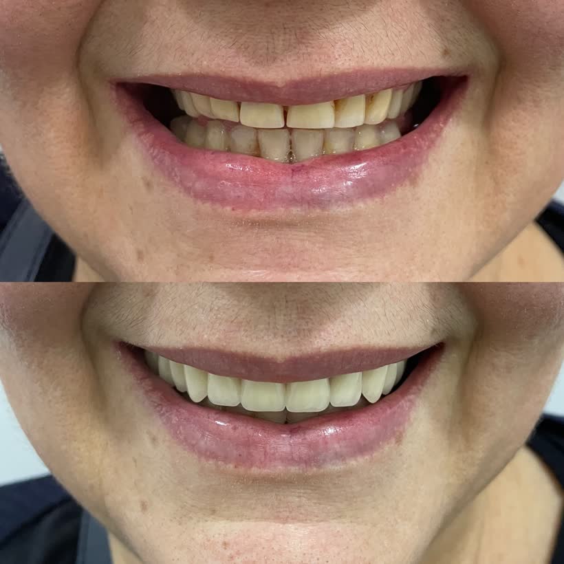 Antes e depois: Reabilitação com prótese
