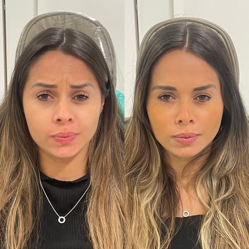 Antes e depois: Botox entre as sobrancelhas
