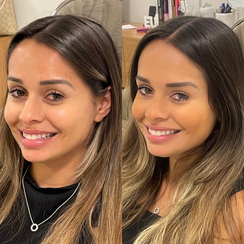 Antes e depois: Harmonização facial