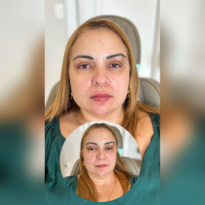 Antes e depois: Harmonização facial