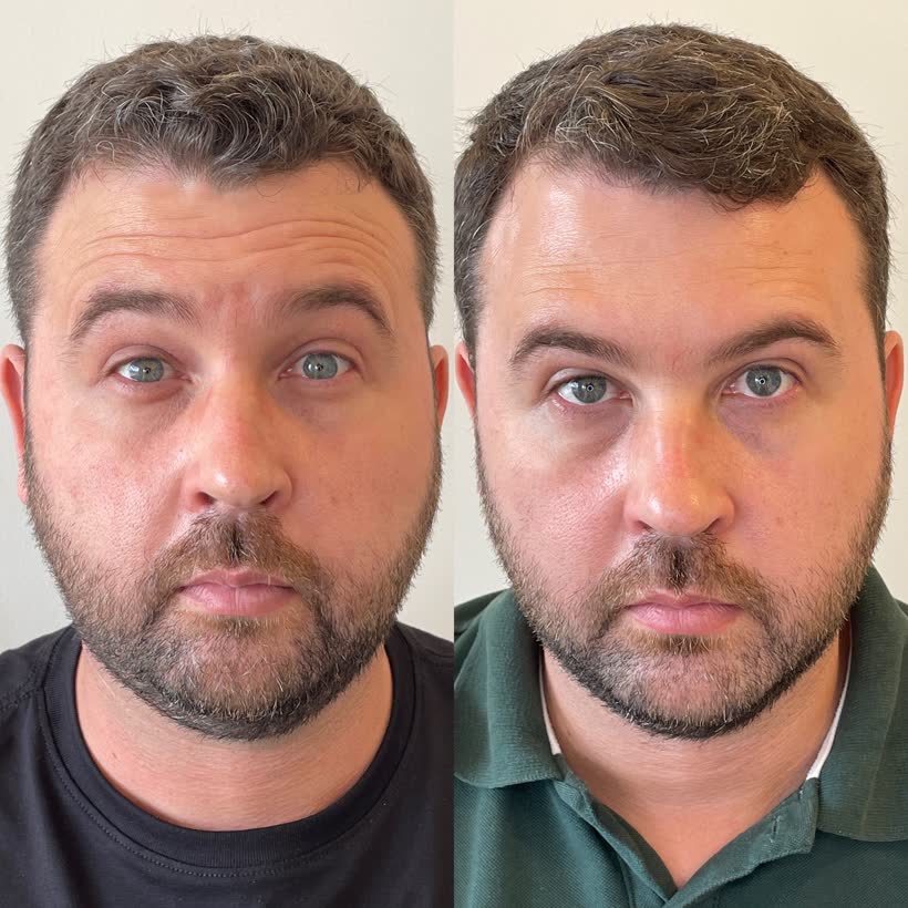 Antes e depois: Harmonização facial