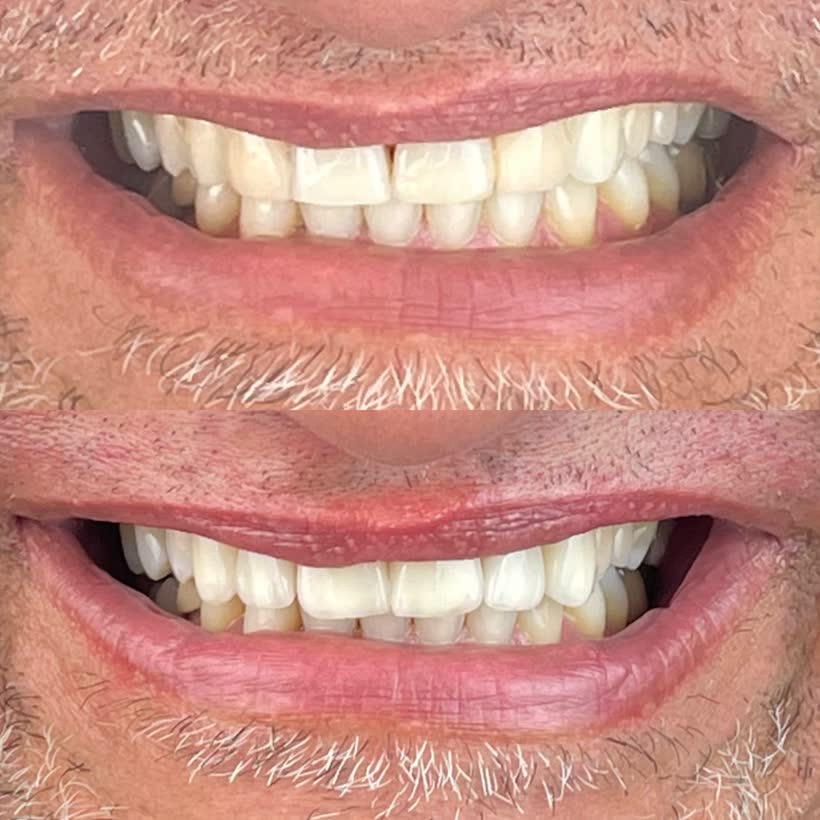 Antes e depois: Lentes de contato dental