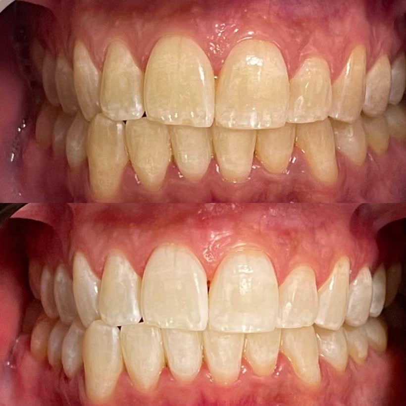 Antes e depois: Clareamento dental