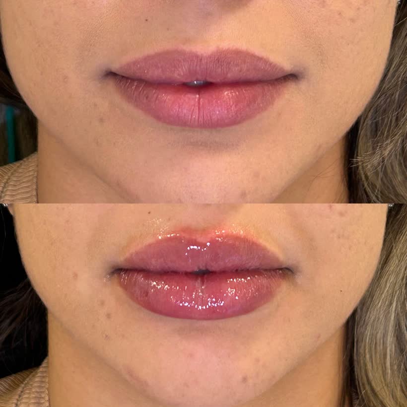 Antes e depois: Preenchimento labial