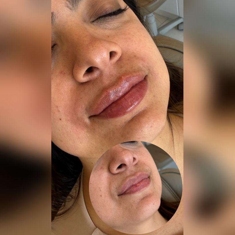 Antes e depois: Preenchimento labial
