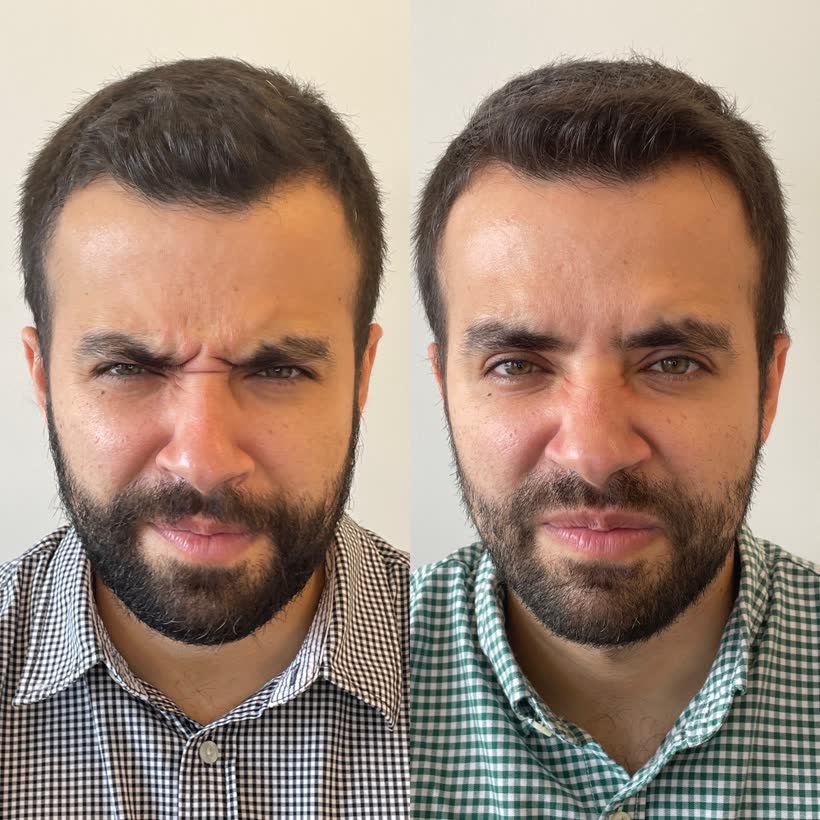 Antes e depois: Botox entre as sobrancelhas