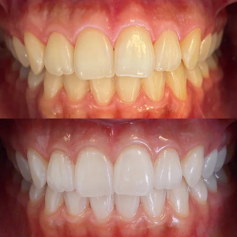Antes e depois: Clareamento dental