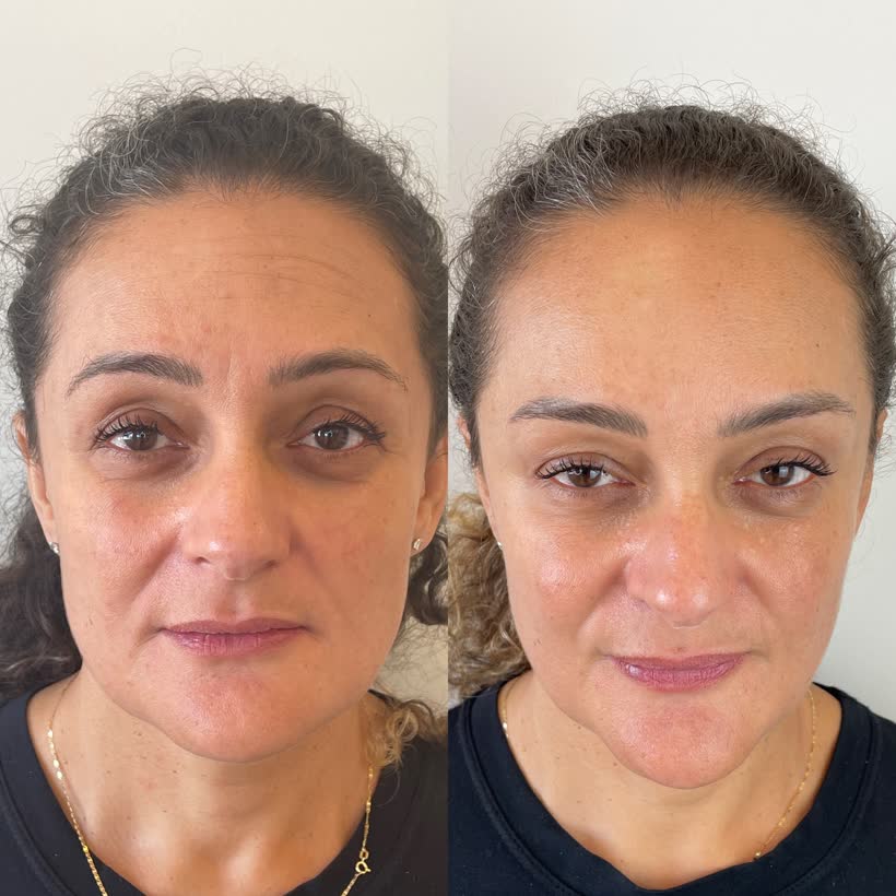 Antes e depois de harmonização facial, paciente da clínica