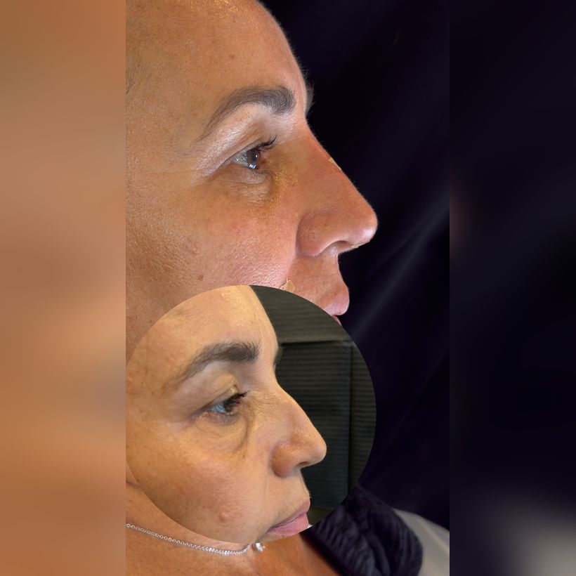 Antes e depois: Botox na região dos olhos