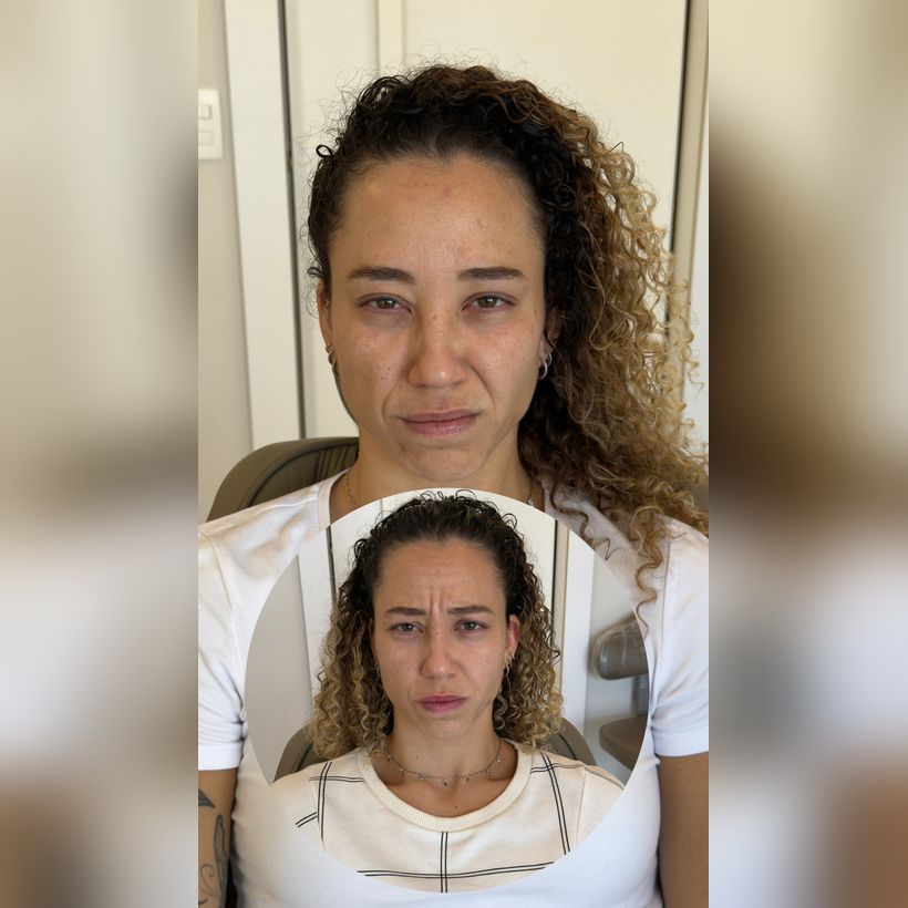 Antes e depois: Botox entre as sobrancelhas