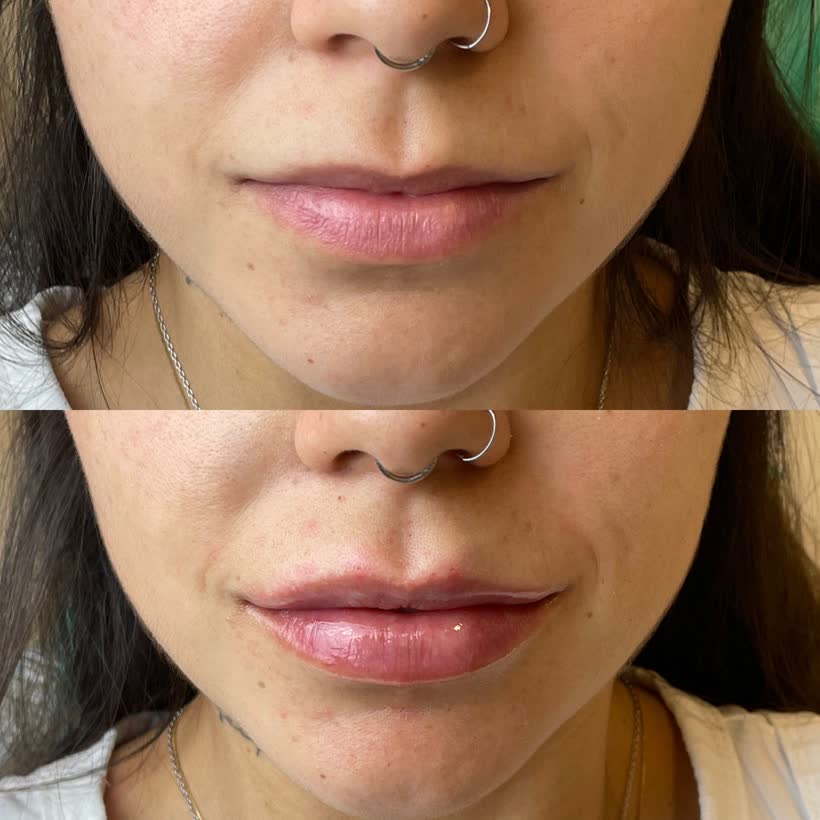 Antes e depois: Preenchimento labial