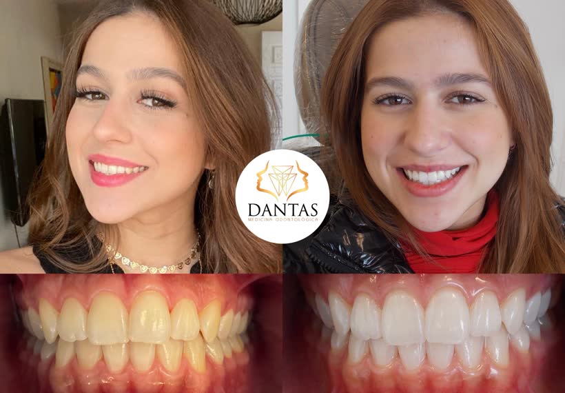 Antes e depois: Lentes de contato dental