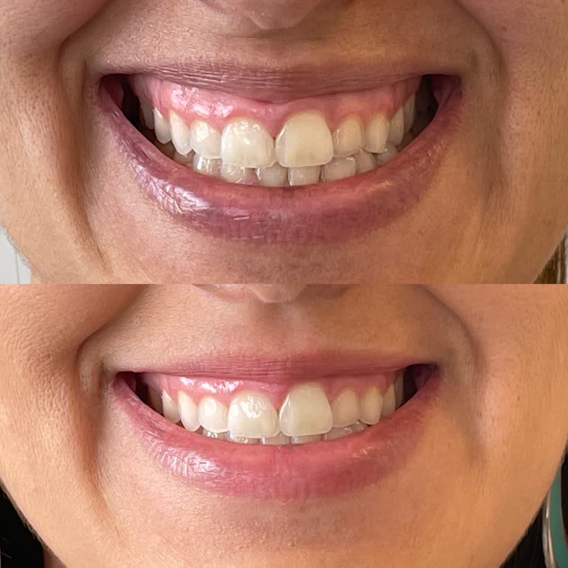 Antes e depois: Botox para sorriso gengival