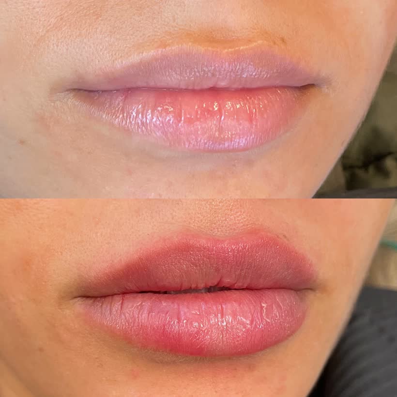 Antes e depois: Preenchimento labial