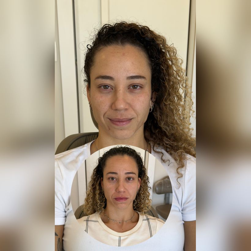 Antes e depois: Harmonização facial