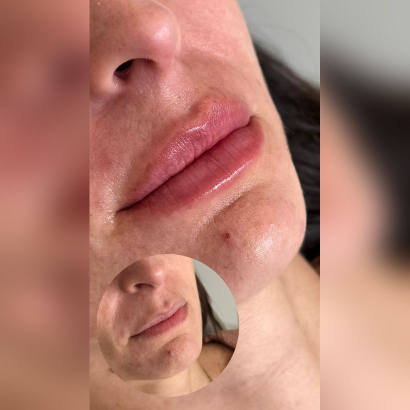 Antes e depois: Preenchimento labial