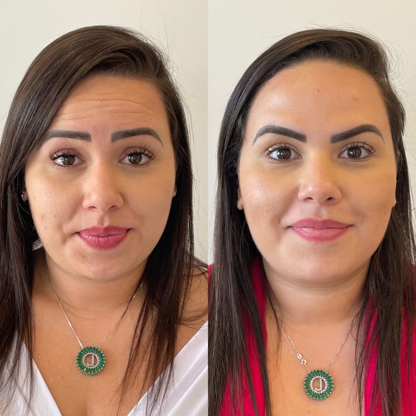Antes e depois: Harmonização facial