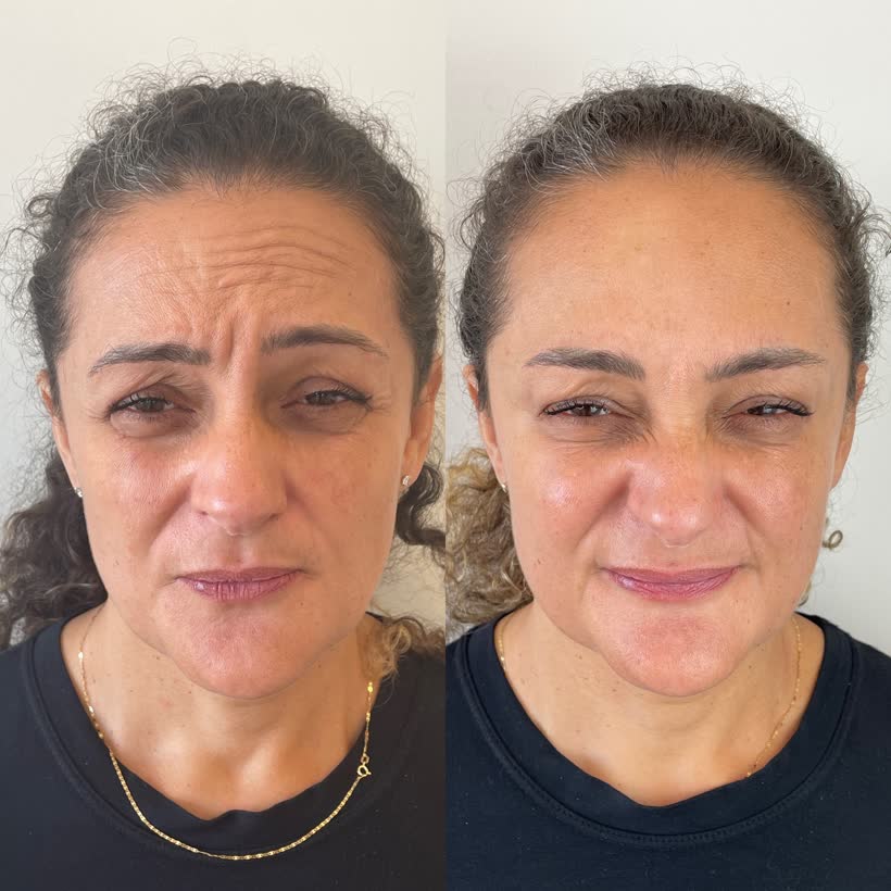 Antes e depois: Botox na testa e glabela