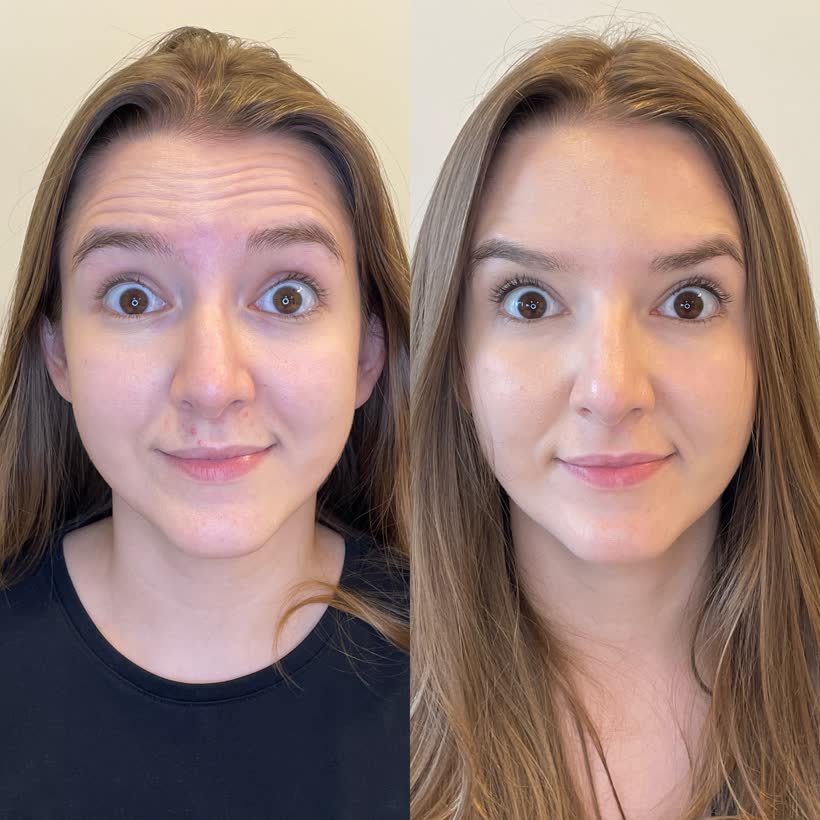 Antes e depois: Botox na testa