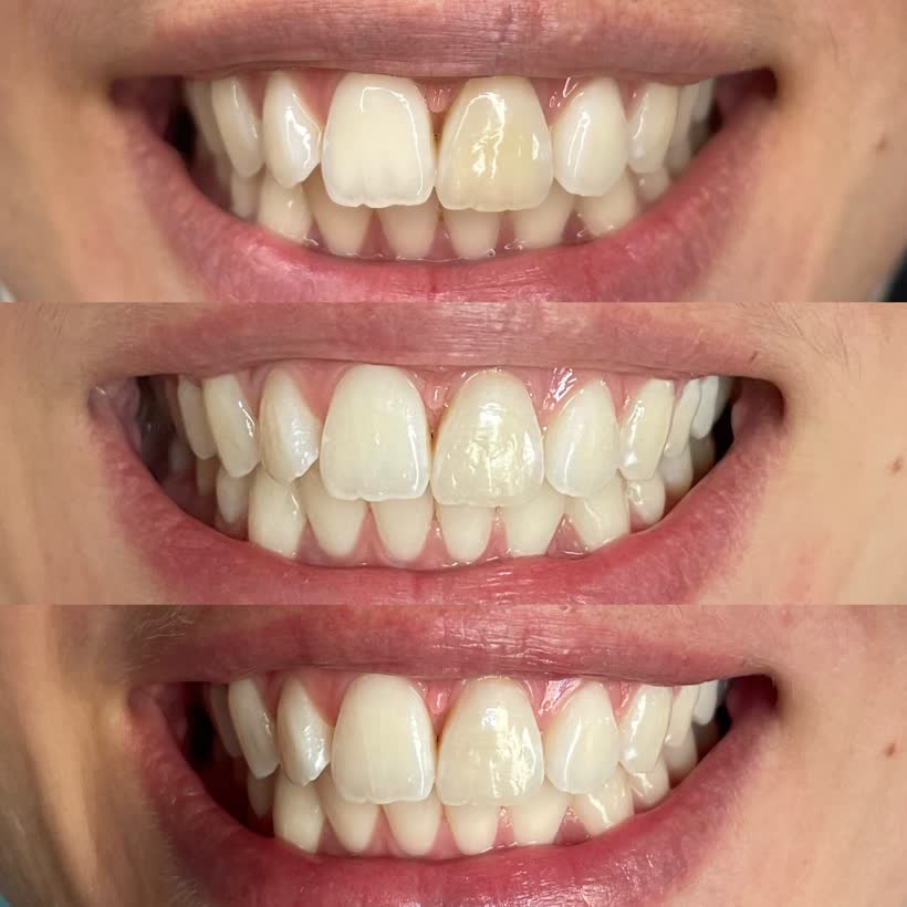 Antes e depois: Clareamento dental