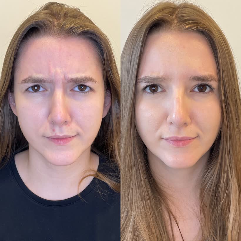 Antes e depois de botox entre as sobrancelhas