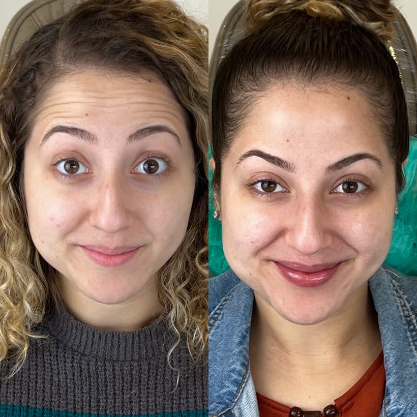 Antes e depois: Botox na testa