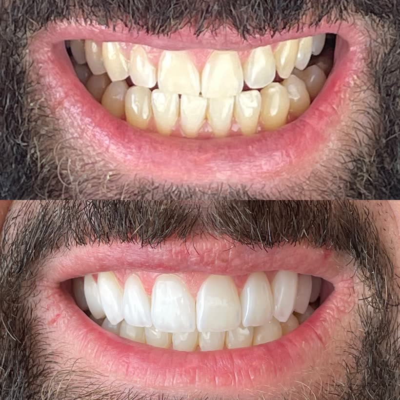 Antes e depois: Lentes de contato dental