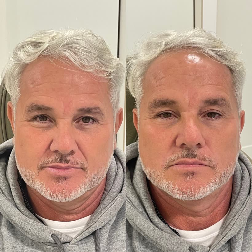 Antes e depois: Harmonização facial