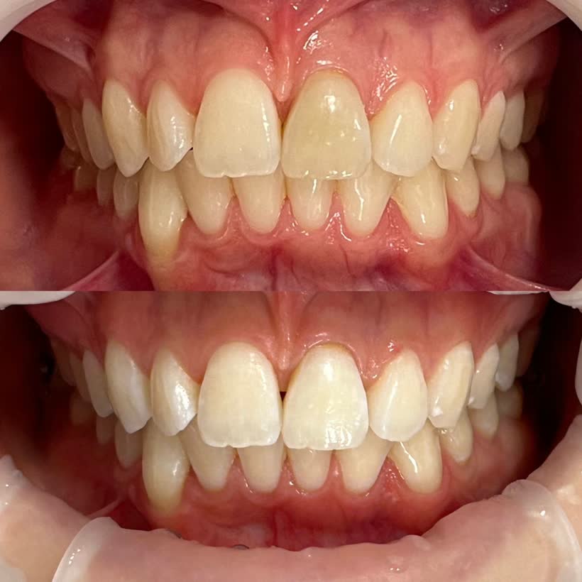 Antes e depois: Clareamento dental
