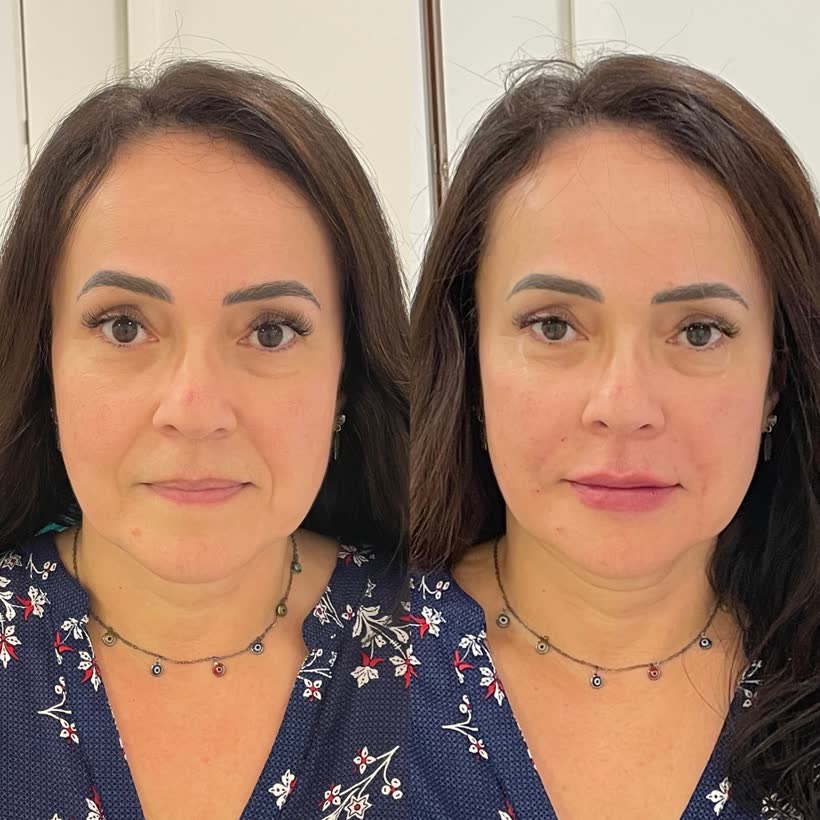 Antes e depois: Harmonização facial