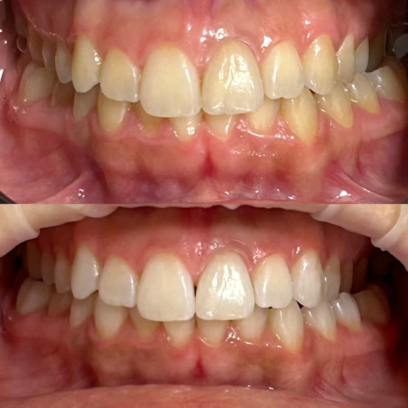 Antes e depois: Clareamento dental