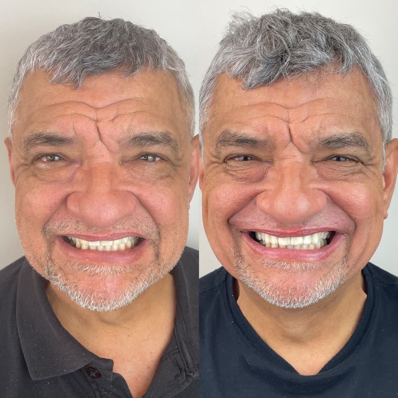 Antes e depois: Lentes de contato dental