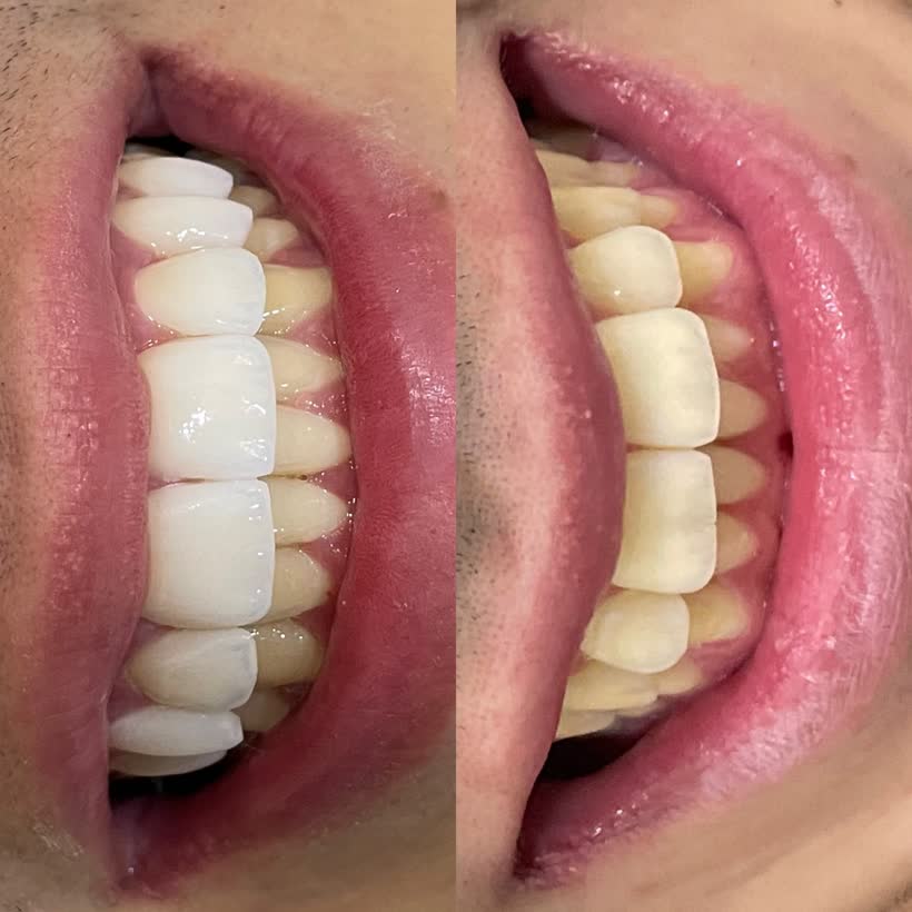 Antes e depois: Lentes de contato dental