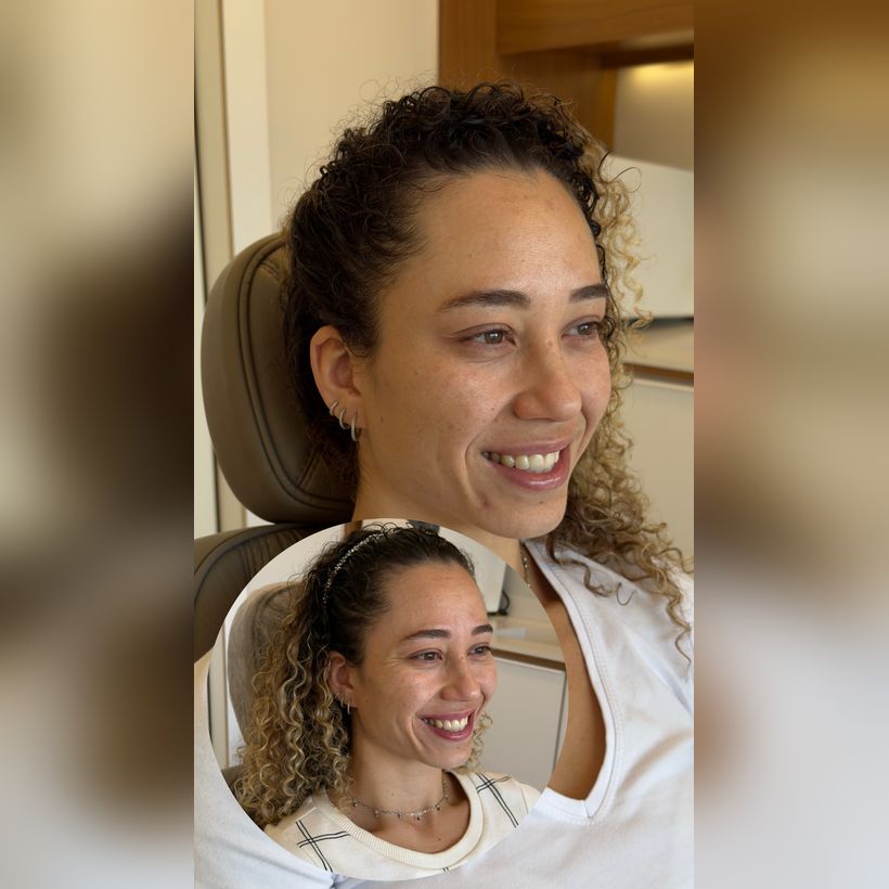 Antes e depois: Botox nos pés de galinha