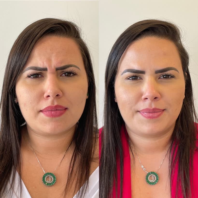 Antes e depois: Botox entre as sobrancelhas