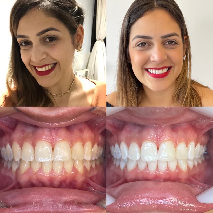 Antes e depois: Clareamento dental