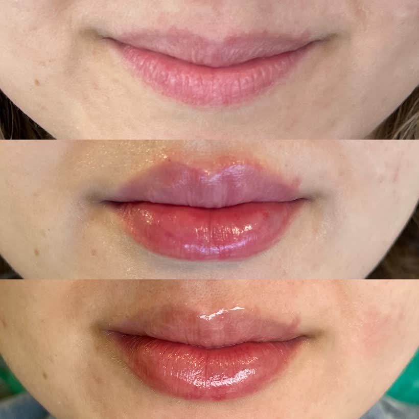 Antes e depois: Preenchimento labial