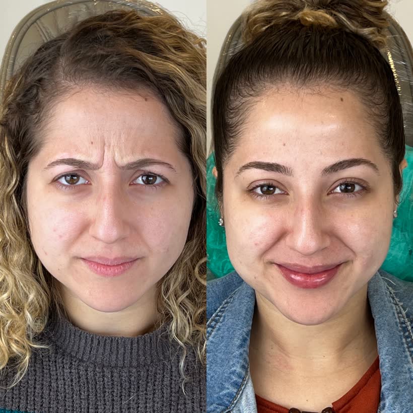 Antes e depois: Botox entre as sobrancelhas