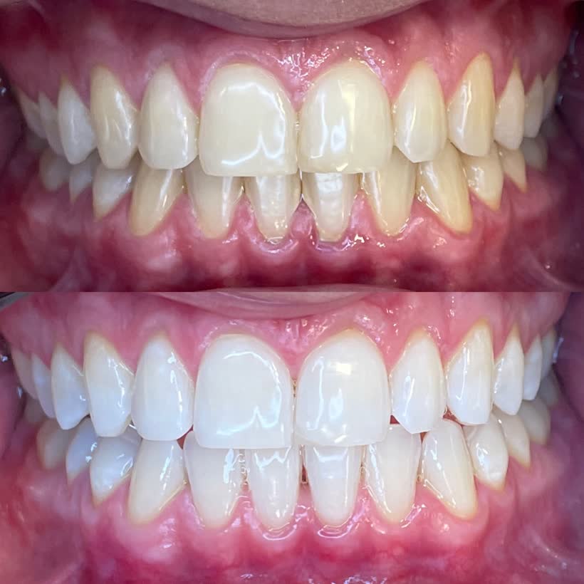 Antes e depois de clareamento dental