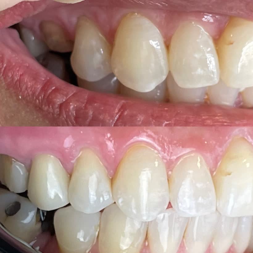 Antes e depois: Restauração estética