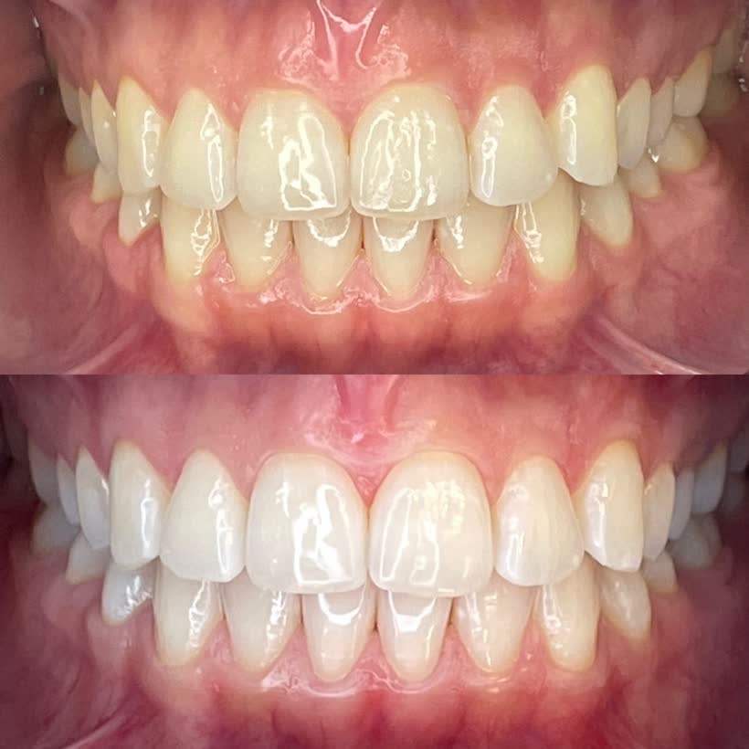 Antes e depois: Clareamento dental