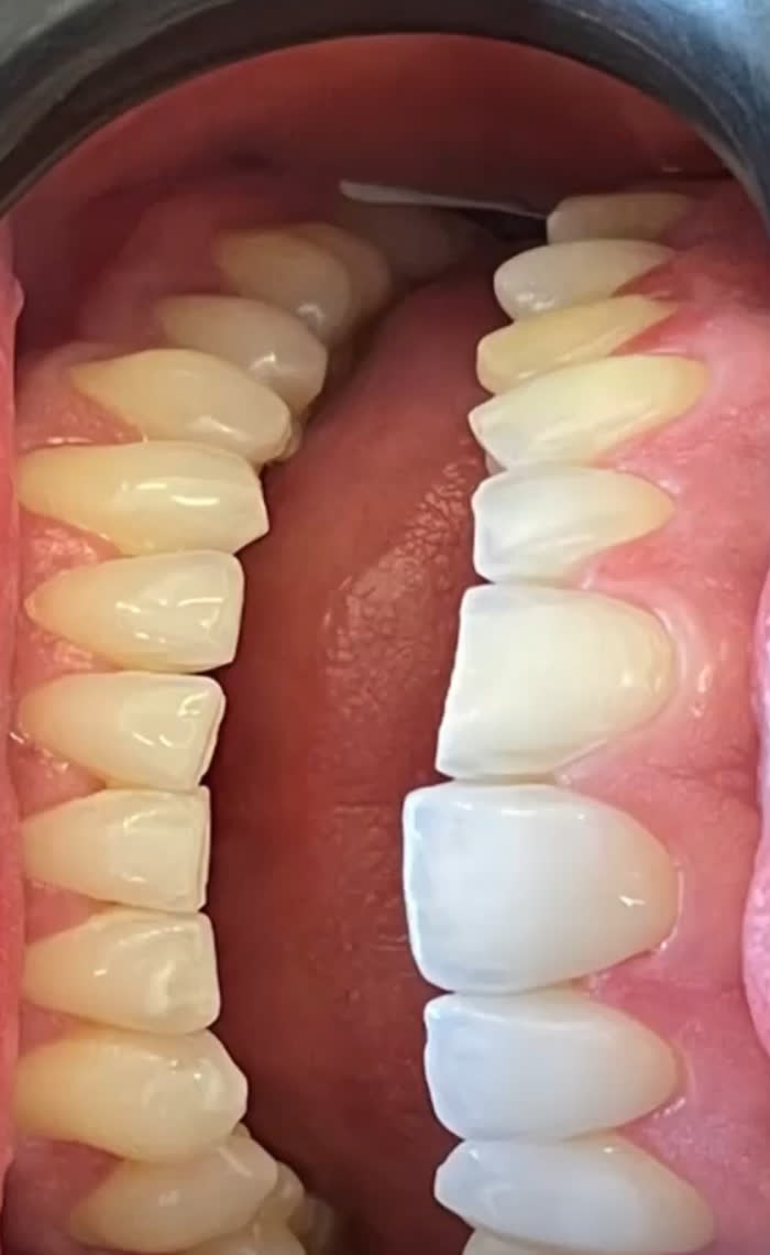 Antes e depois: Lentes: antes e depois lado a lado