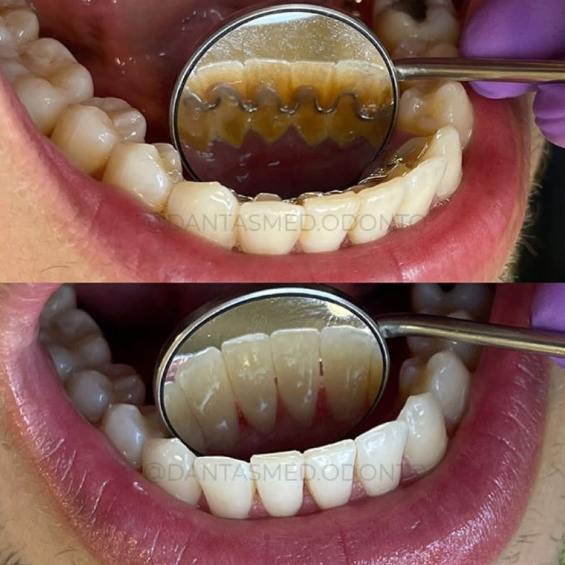 Antes e depois de limpeza profissional